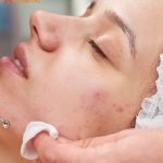 Acne Facial Treatment Penang